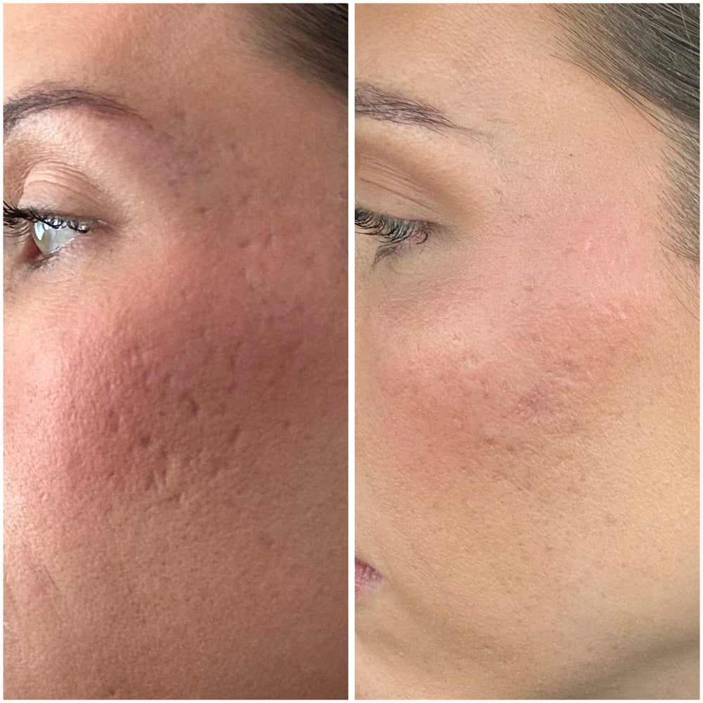 <p>Clinical-Level Skin Results, At Home</p>